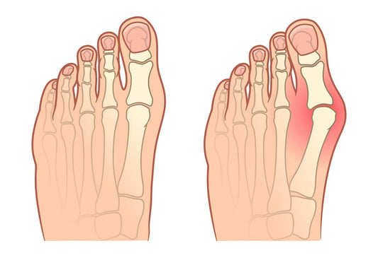 Varför får man hallux valgus?