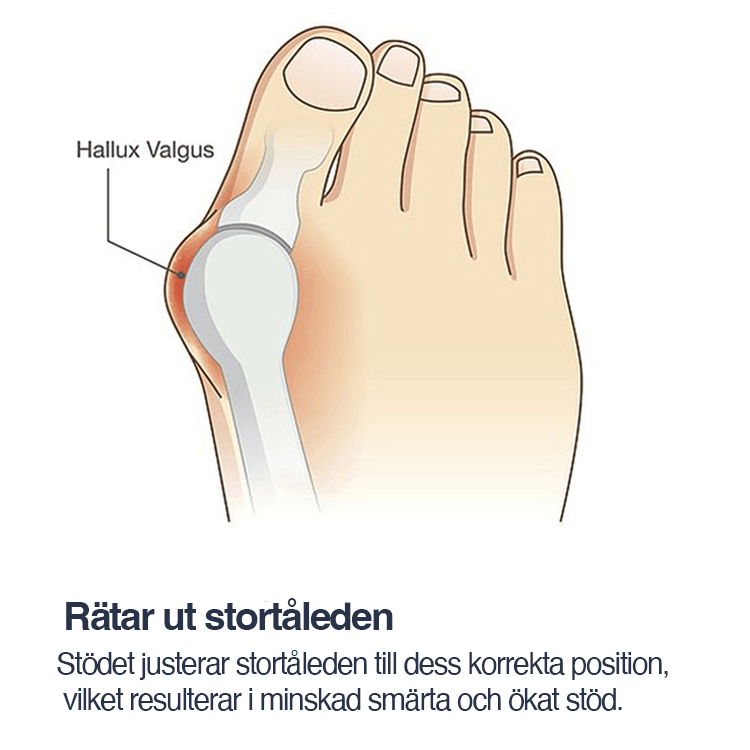 Stöd med tåseparerare som används på foten vid hallux valgus