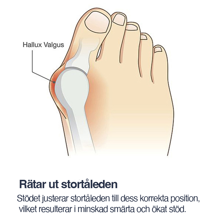 Korrigerande stöd med tåseparerare (2 st), Hallux Valgus