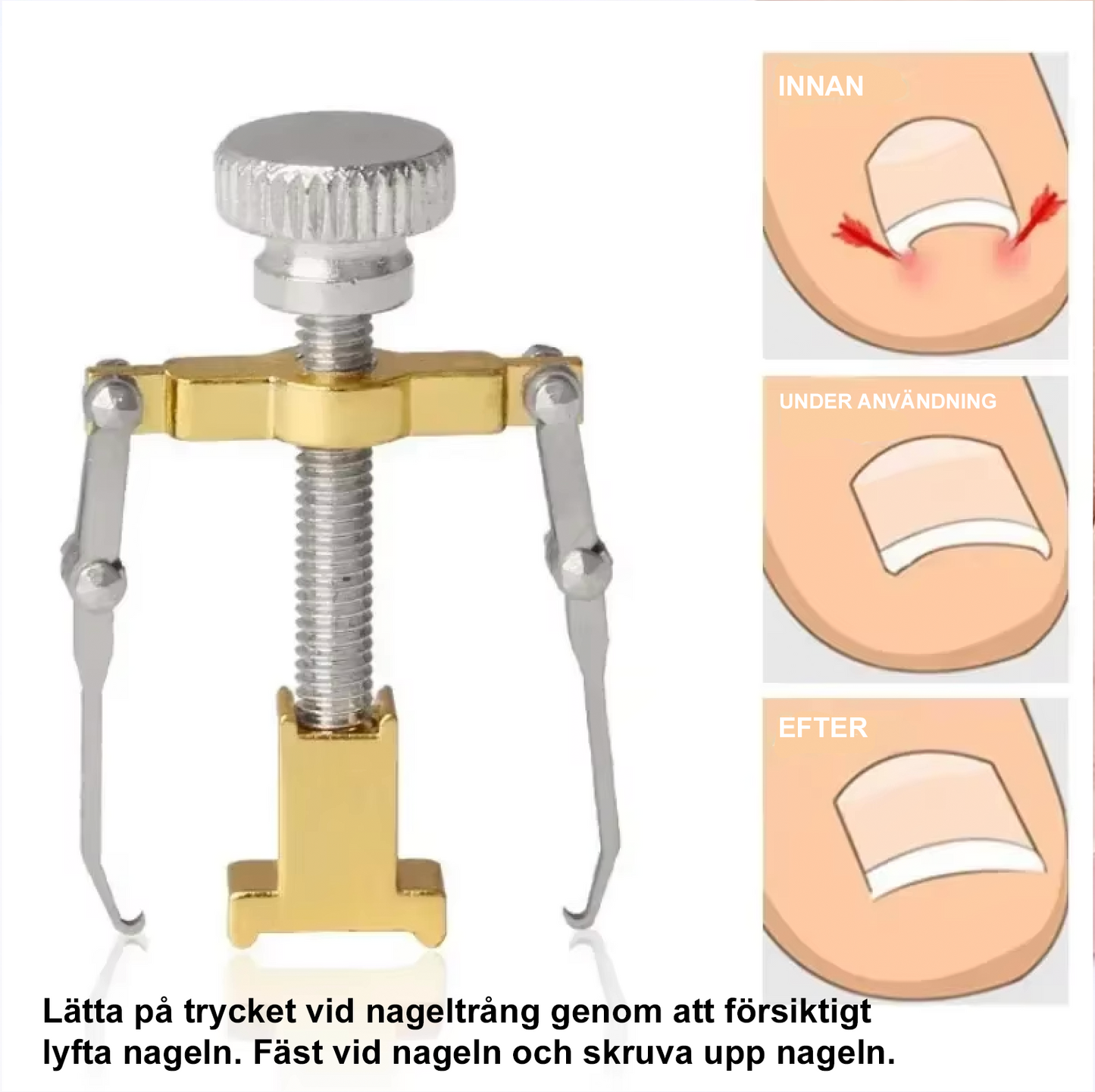 Verktyg för att lyfta nagel vid nageltrång med illustration av före, under användning och efter resultat.